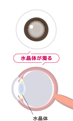 水晶体が濁った状態のイメージ図